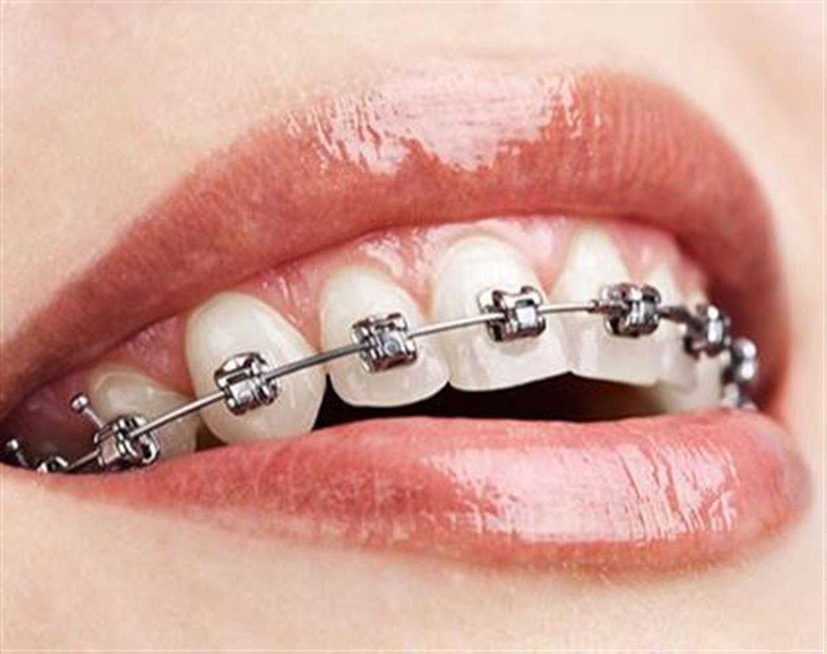 dental metal braces sharjah uae clinic wired