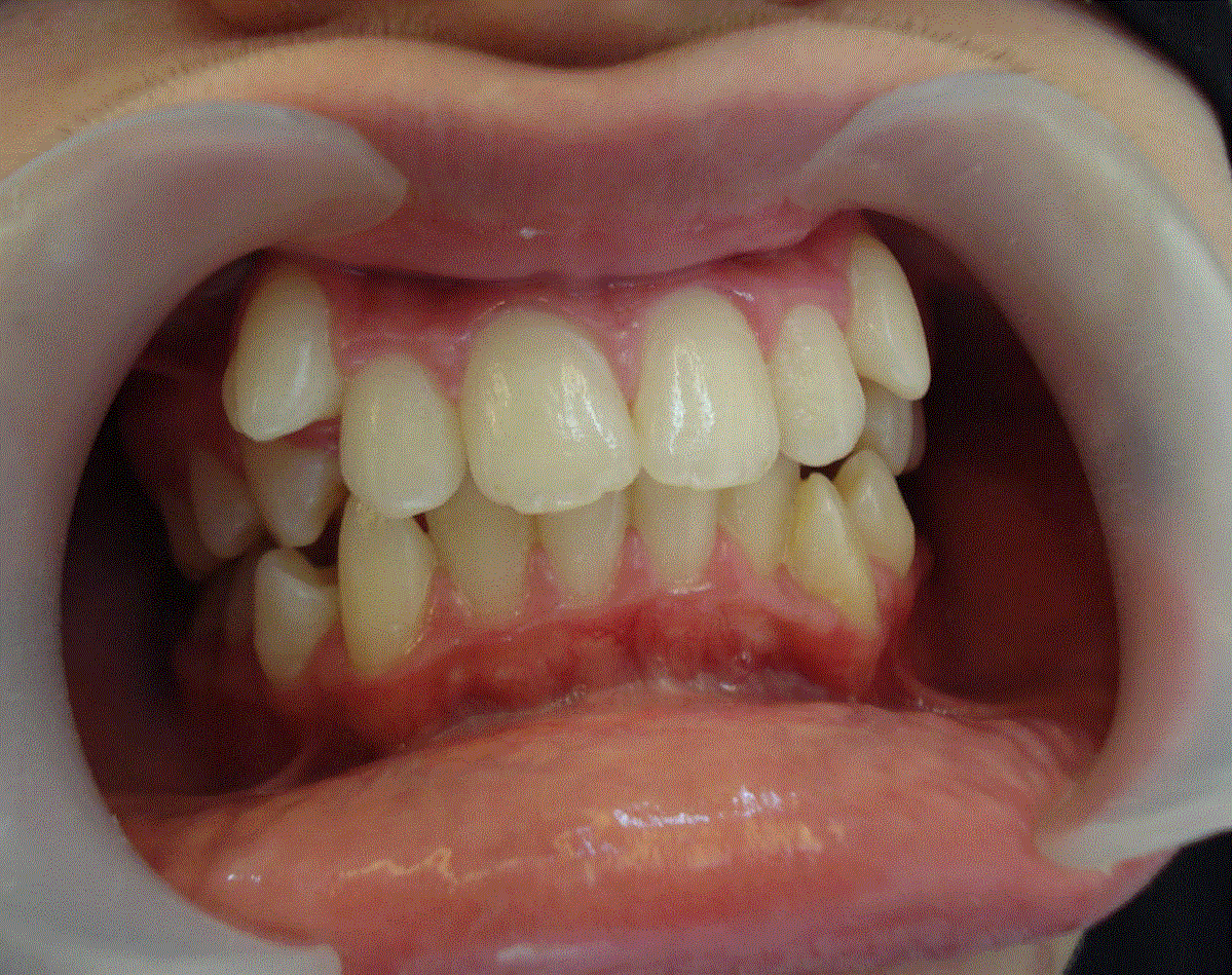 before braces orthodontics orchid medical center sharjah uae