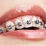تقويم الاسنان اسلاك معدني الامارات اوركيد