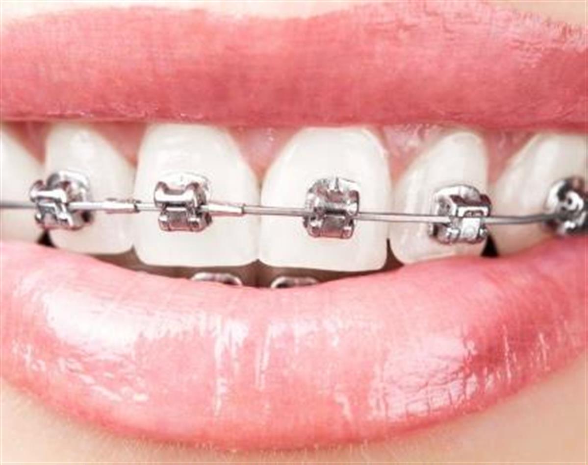 تقويم الاسنان السريع الشارقة اوركيد عيادة