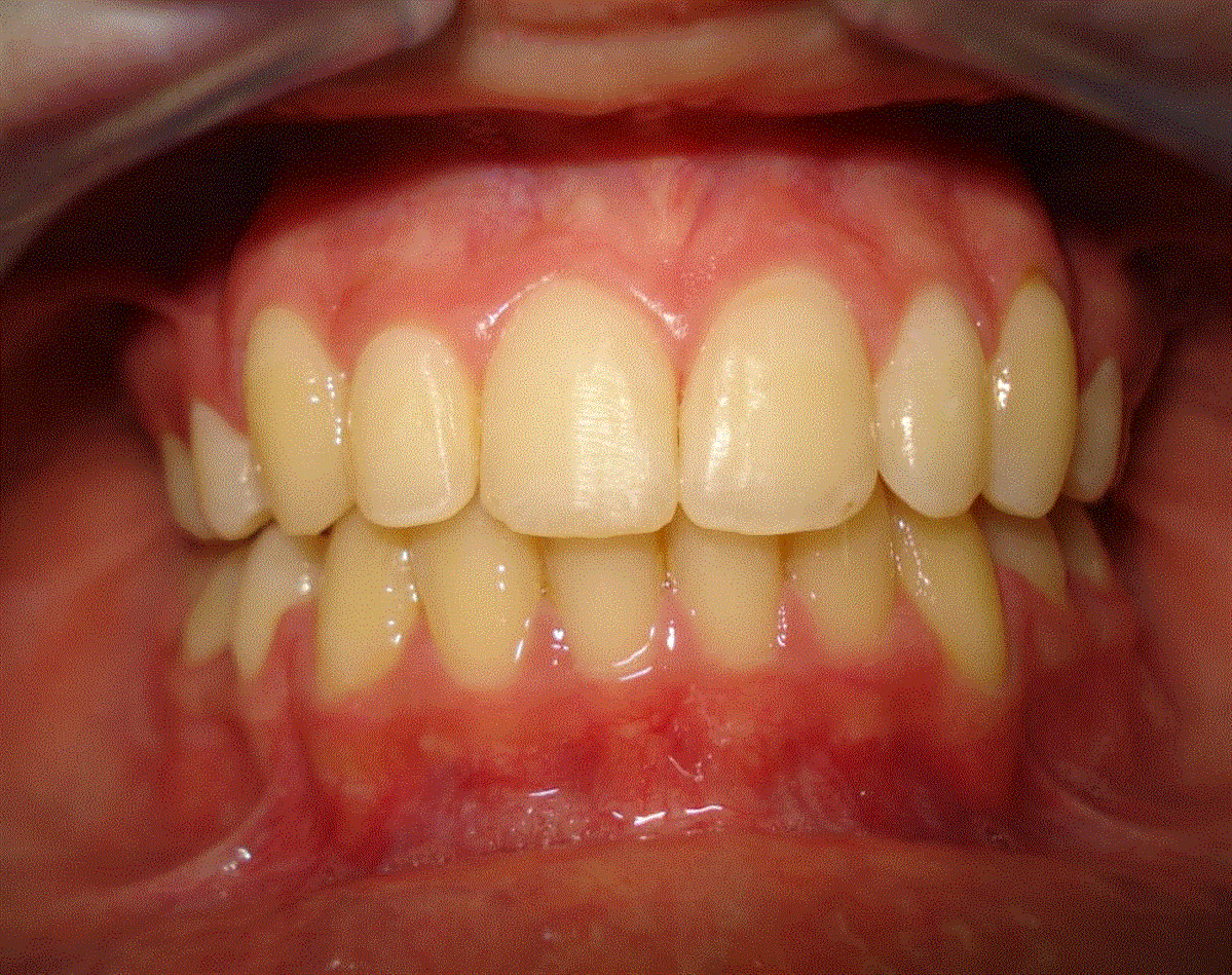 بعد تقويم الاسنان عيادة اسنان اوركيد الشارقة 