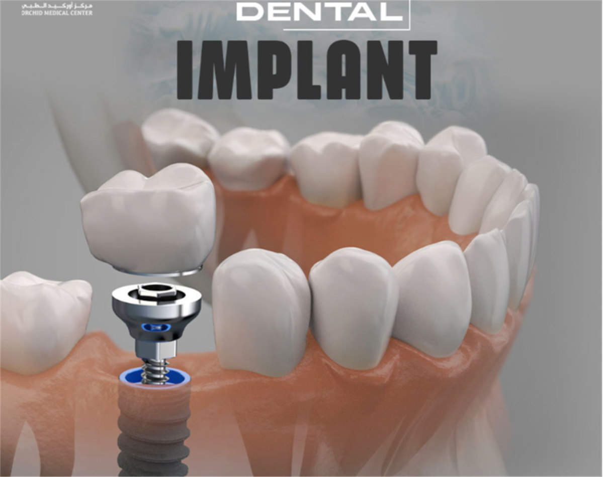 Dental Implant Sharjah Clinic