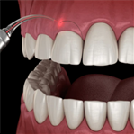 Gum cut dental clinic sharjah