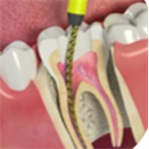 Root canal treatment sharjah