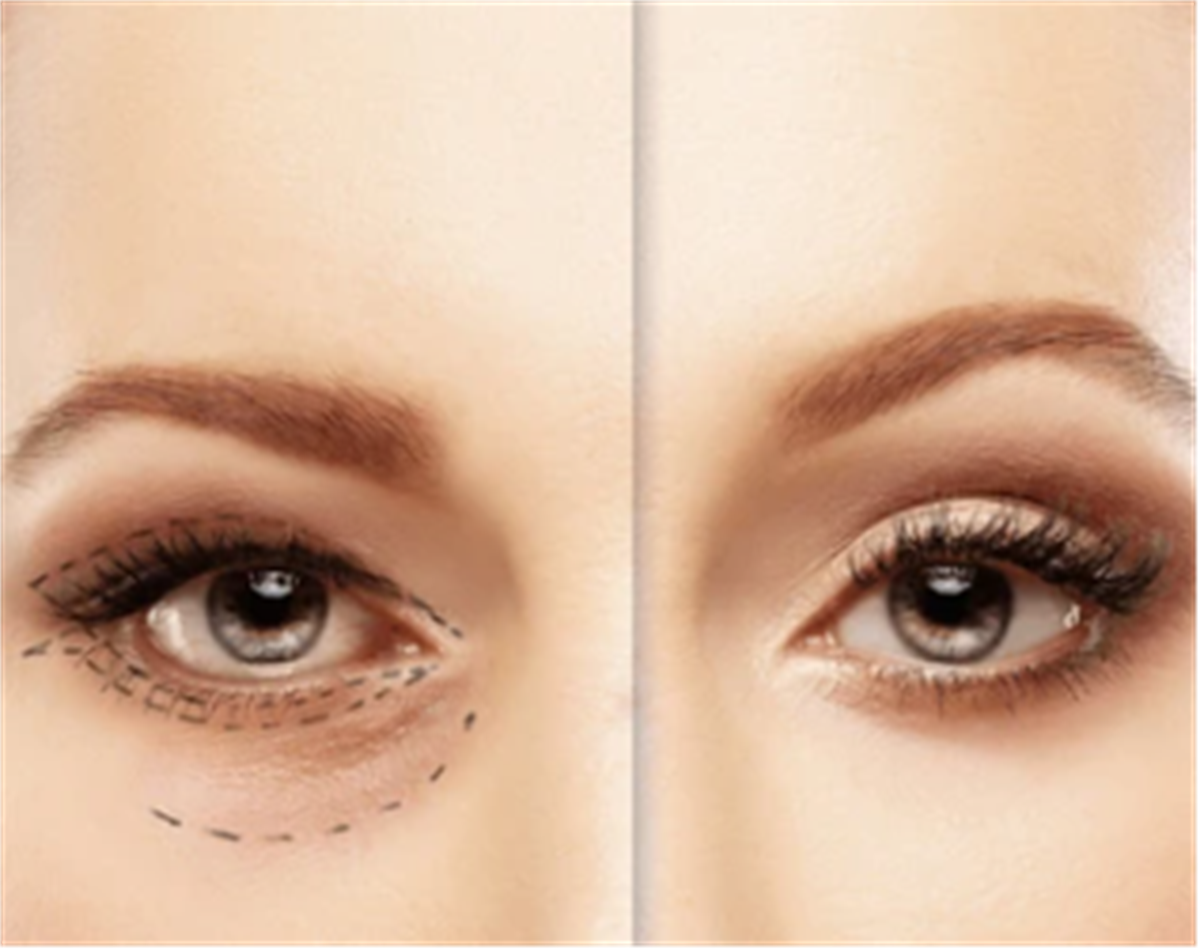 Lower Blepharoplasty surgery clinic Sharjah Orchid