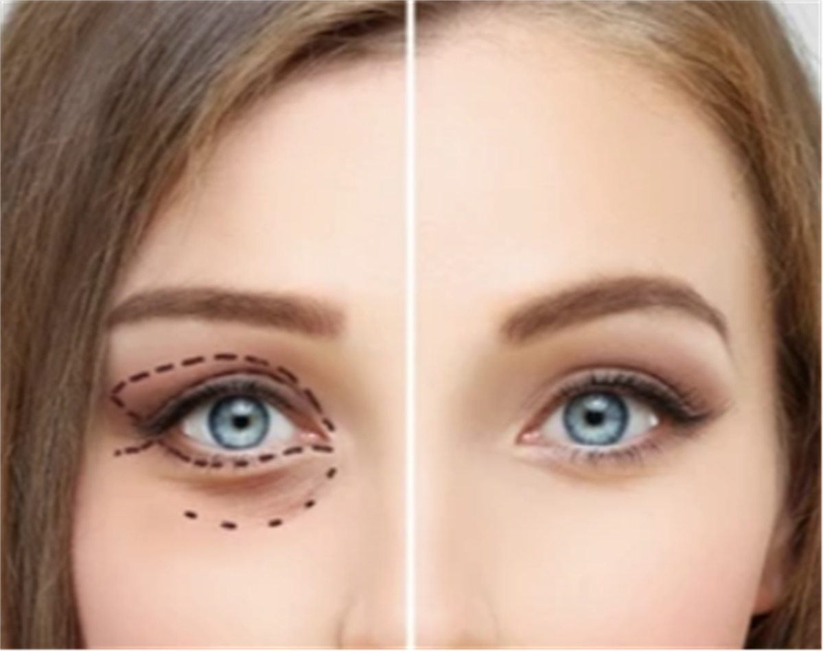 Upper and Lower Eyelid Surgery Clinic Sharjah Orchid